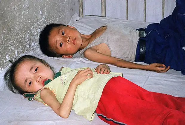 Дети — жертвы голода в КНДР, июнь 1997 года Фото: Reuters