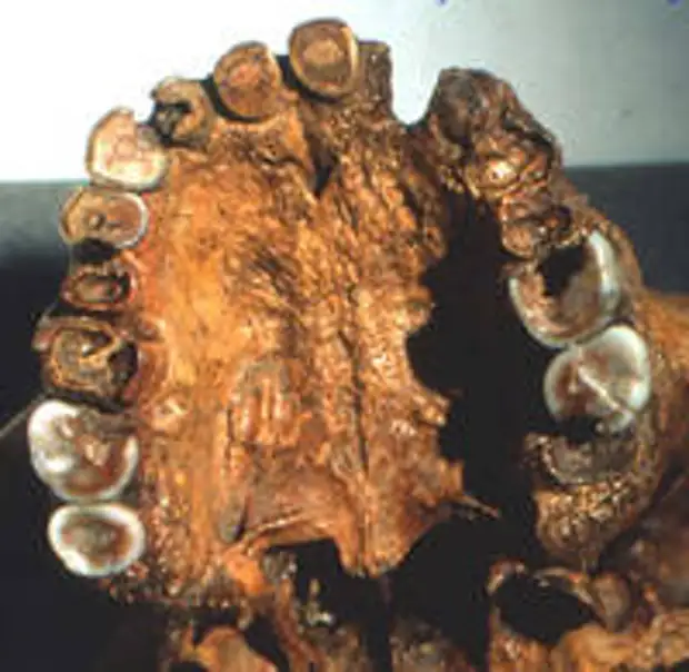 Зубы человека из Брокен-Хилл изъедены кариесом… Источник: http://www.biusante.parisdescartes.fr/  sfhad/vol7/article01.htm